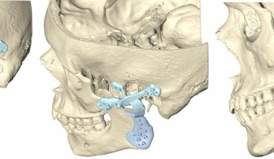 La reconstrucción de la articulación temporomandibular por un tumor requiere diseñar una prótesis a medida